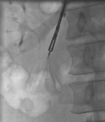 IVC Filter Removal